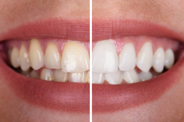 Dental treatment before and after result
